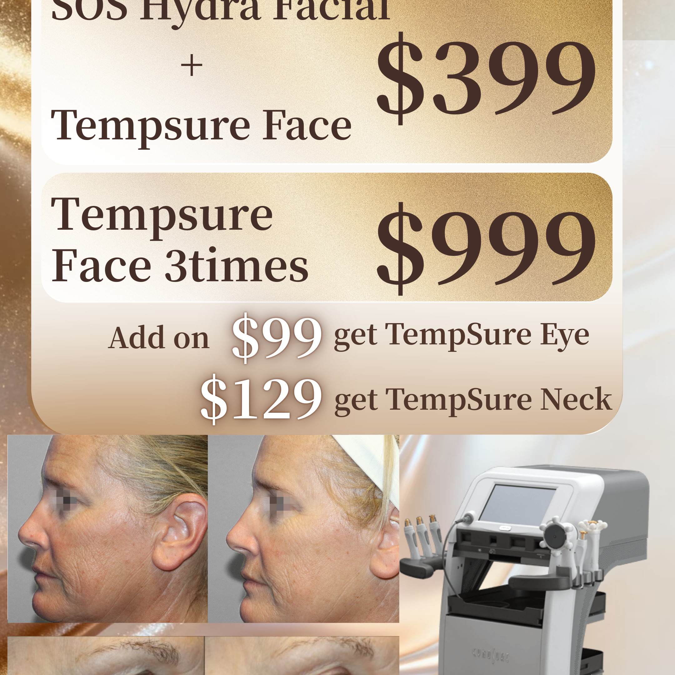 RF Lifting - TempSure