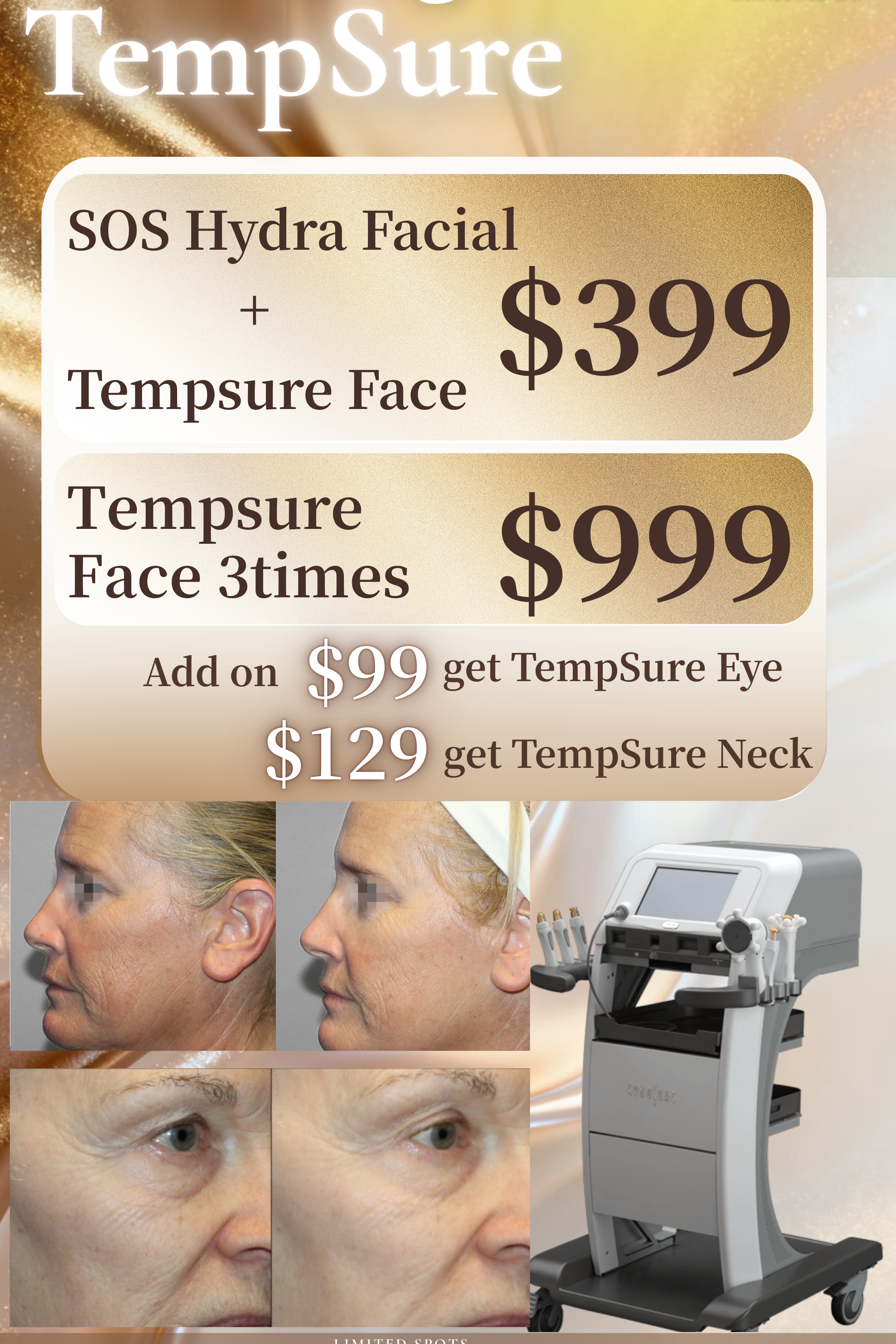 RF Lifting - TempSure