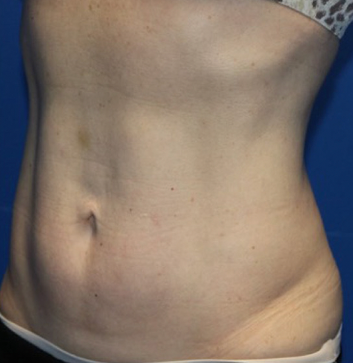 About FLEXSURE™ Mernov Medi Spa